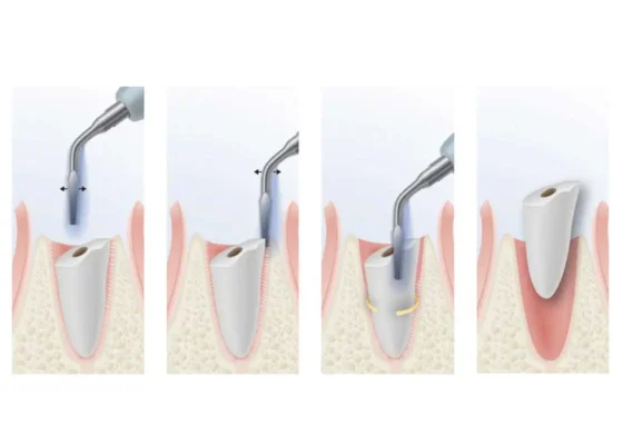 nhổ răng máy piezotome