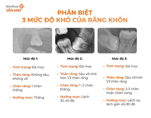 phân biệt mức độ khó của răng khôn