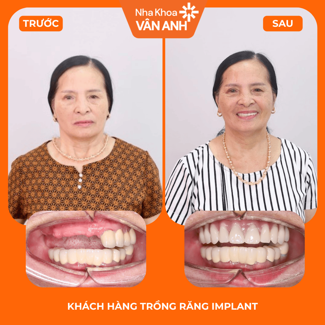 Ca 02 trước và sau điều trị