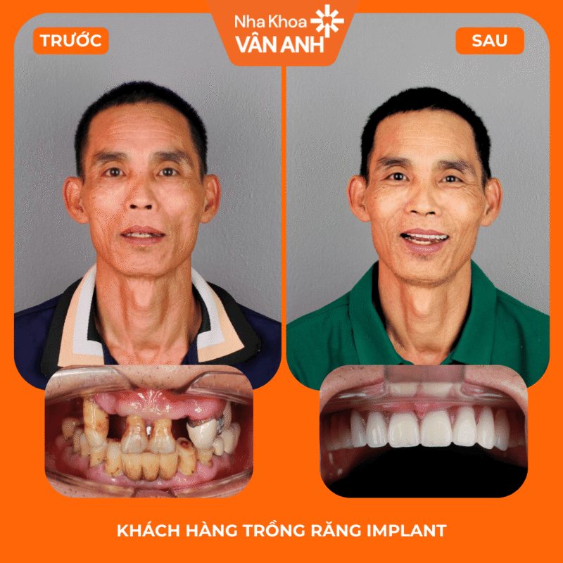 trồng răng implant toàn hàm nha khoa vân anh
