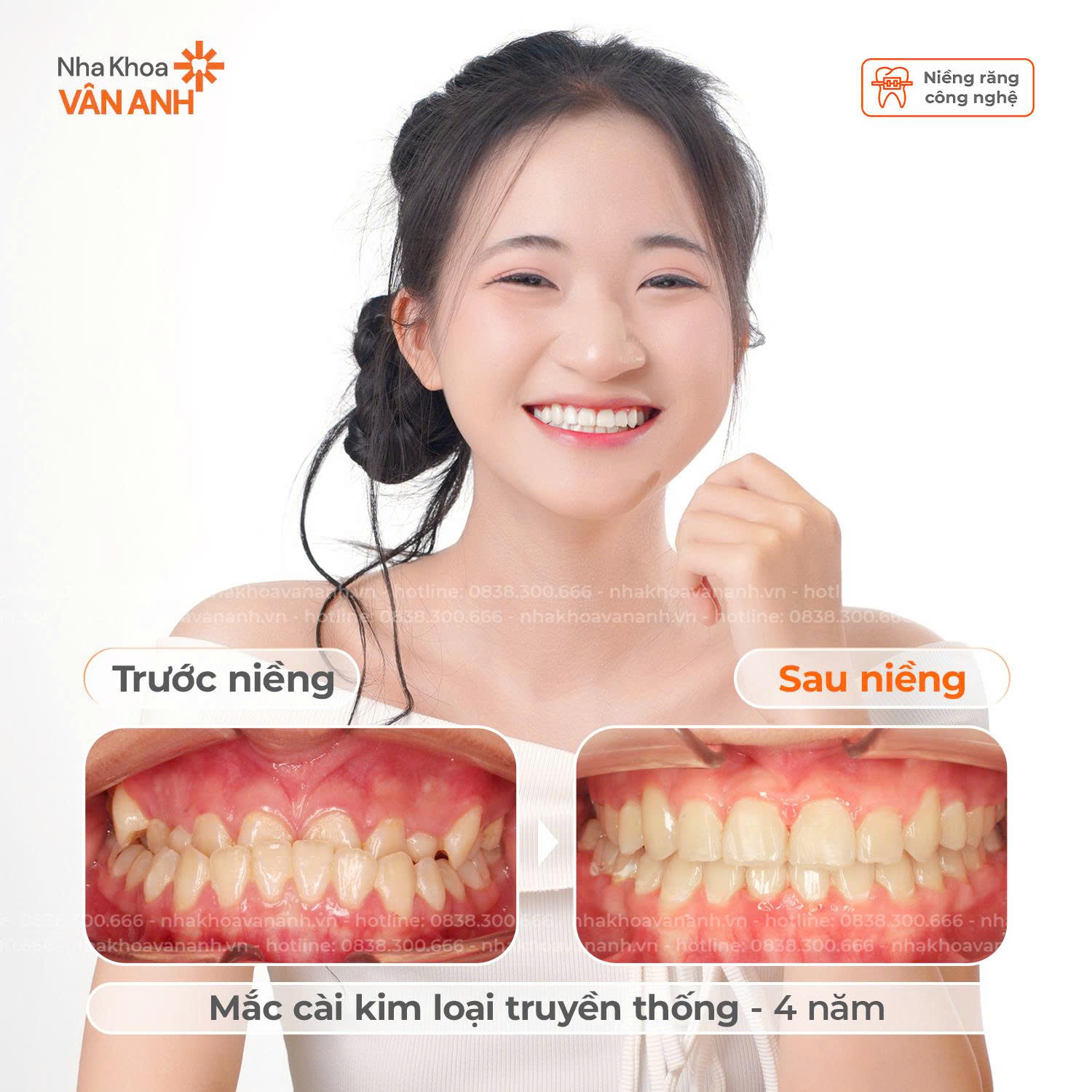 niềng răng nha khoa vân anh