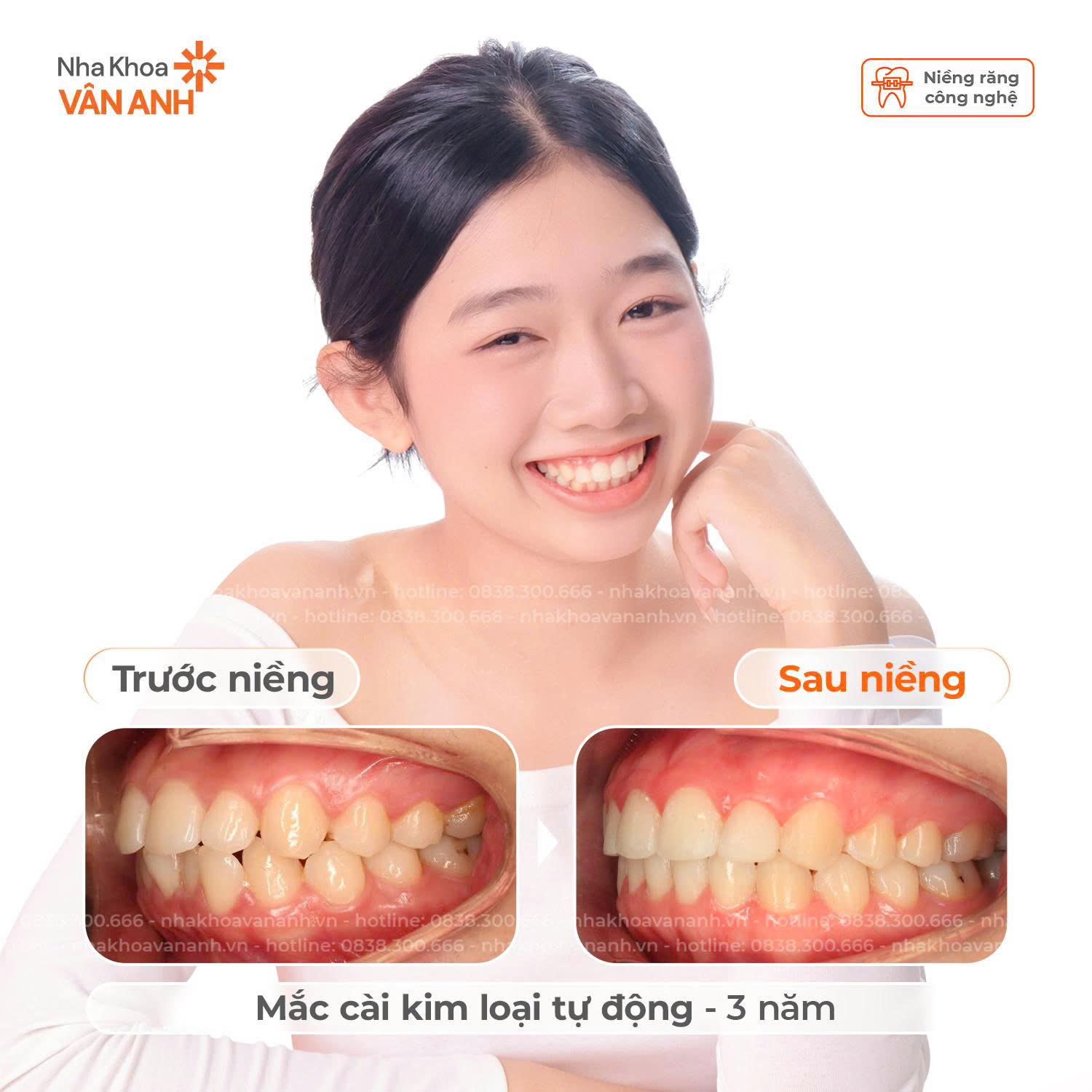niềng răng nha khoa vân anh