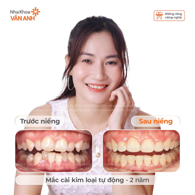 niềng răng nha khoa vân anh