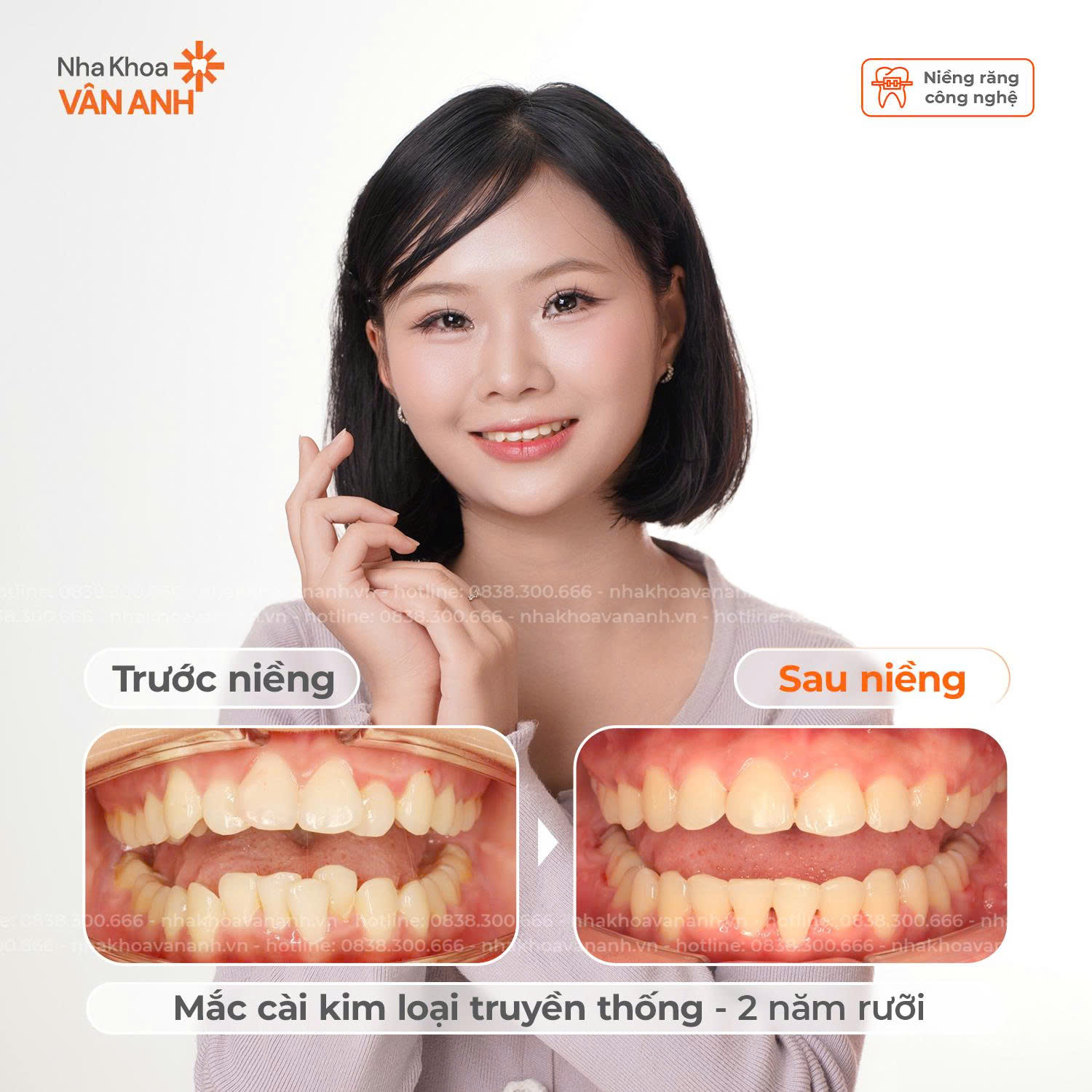 niềng răng nha khoa vân anh