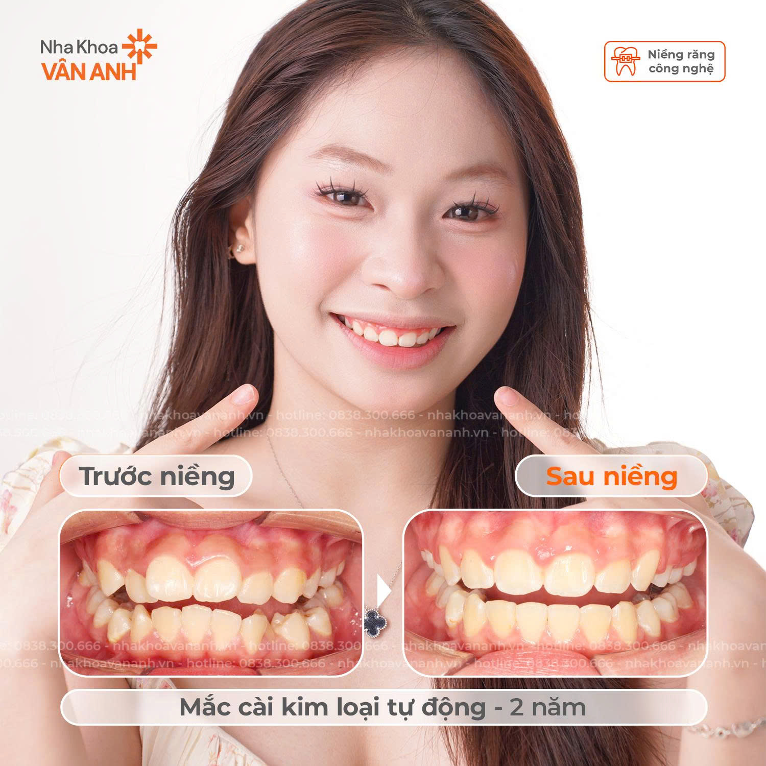 niềng răng nha khoa vân anh