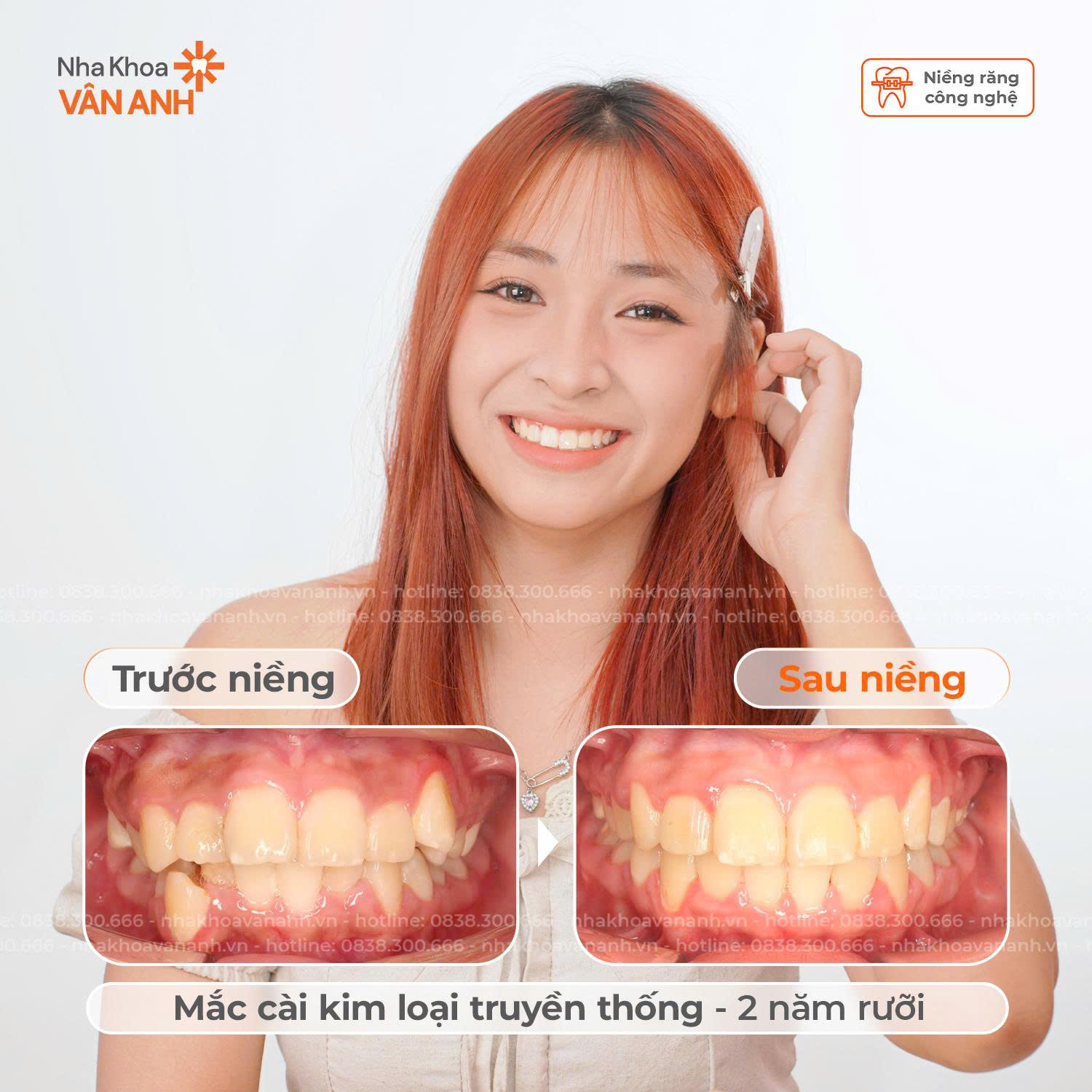 niềng răng nha khoa vân anh