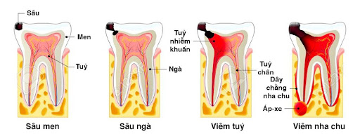các giai đoạn sâu răng