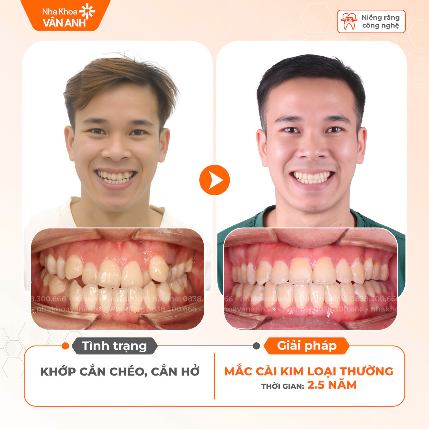 niềng răng nha khoa vân anh