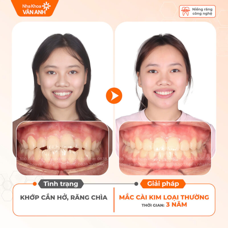 niềng răng nha khoa vân anh