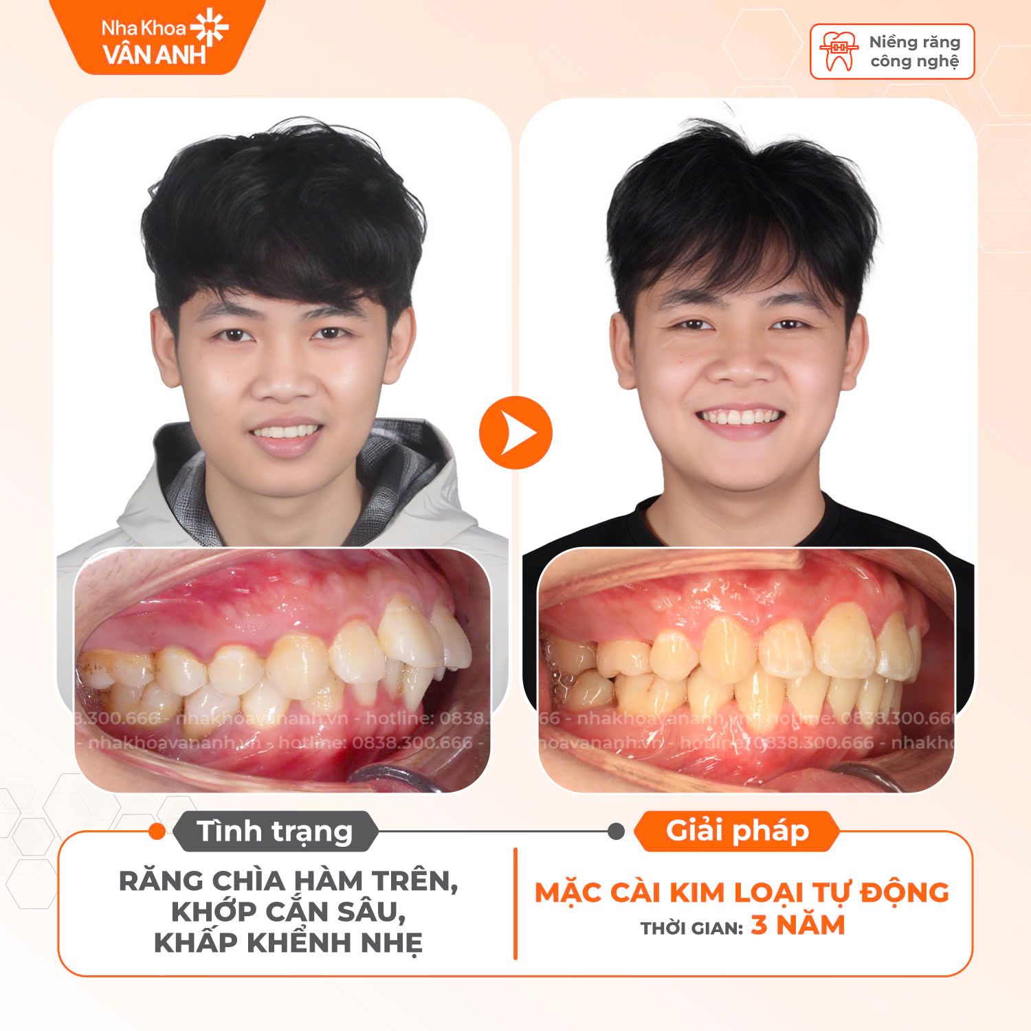 niềng răng nha khoa vân anh