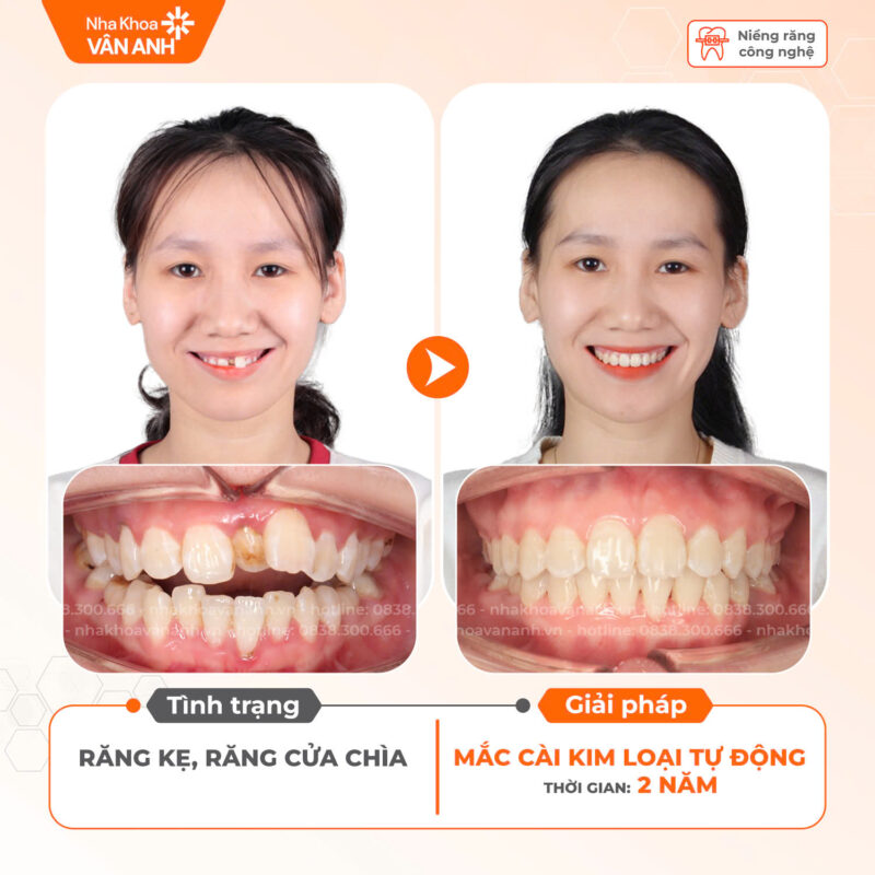 niềng răng nha khoa vân anh