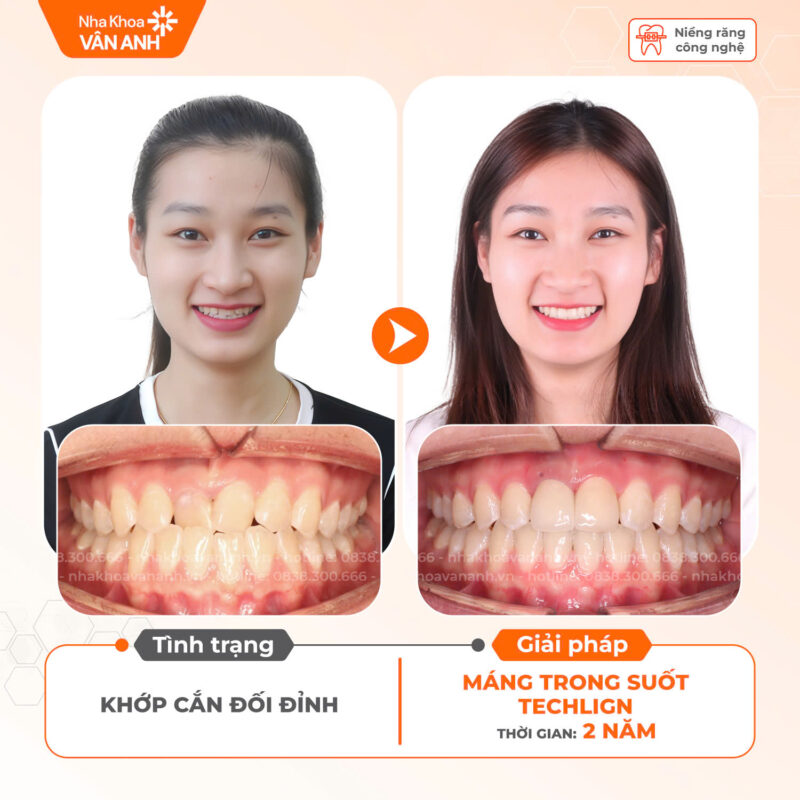 niềng răng nha khoa vân anh