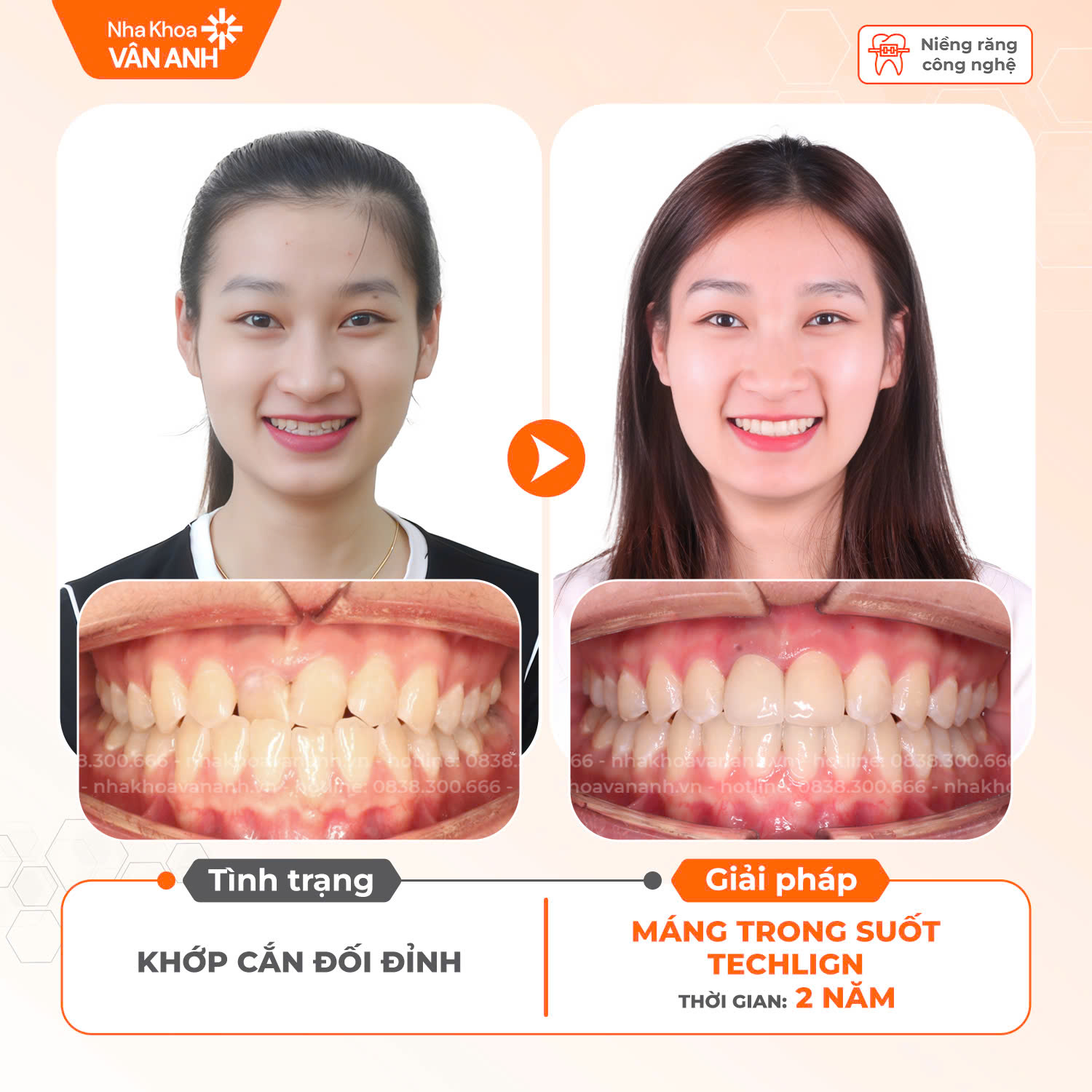 niềng răng nha khoa vân anh