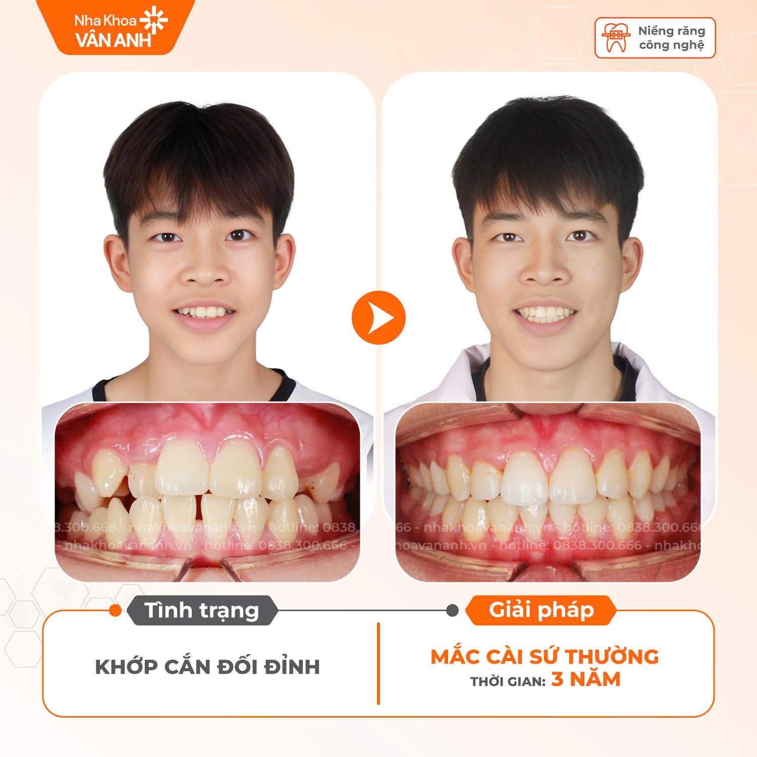 niềng răng nha khoa vân anh