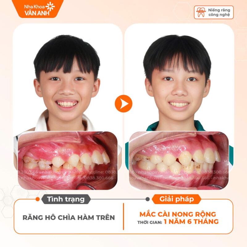 niềng răng nha khoa vân anh