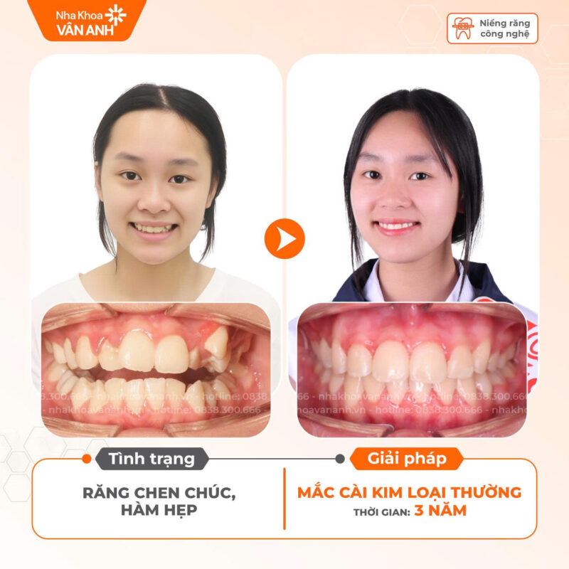 niềng răng nha khoa vân anh