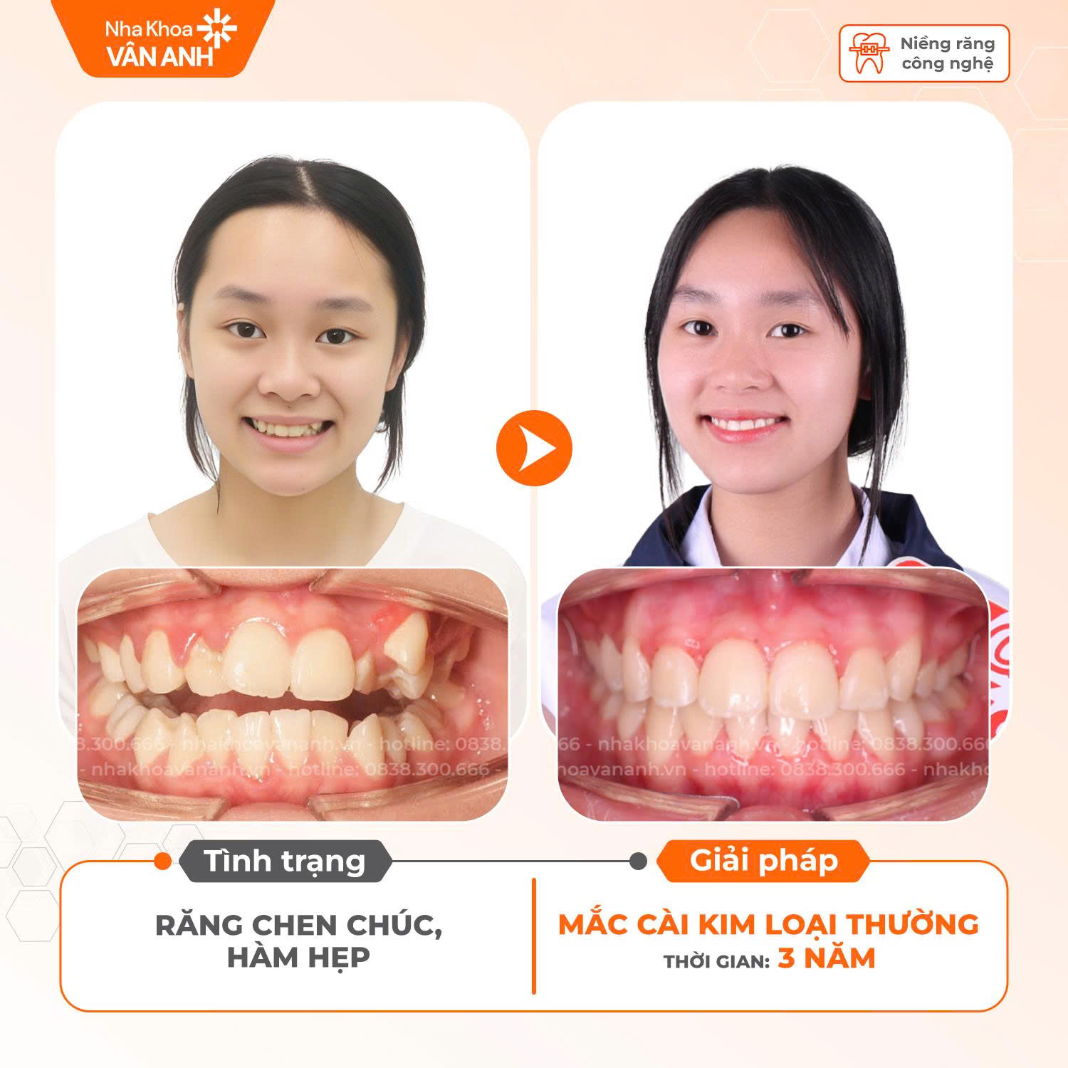 niềng răng nha khoa vân anh