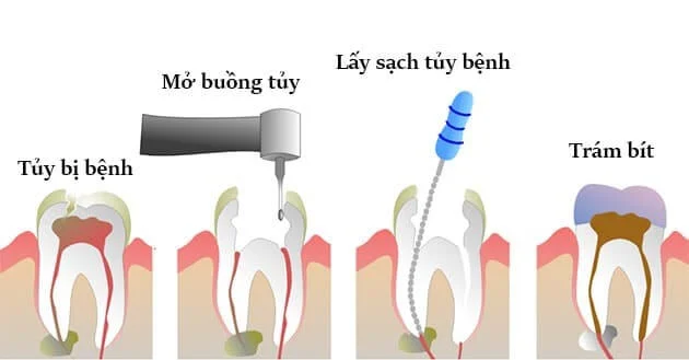 lấy tủy răng