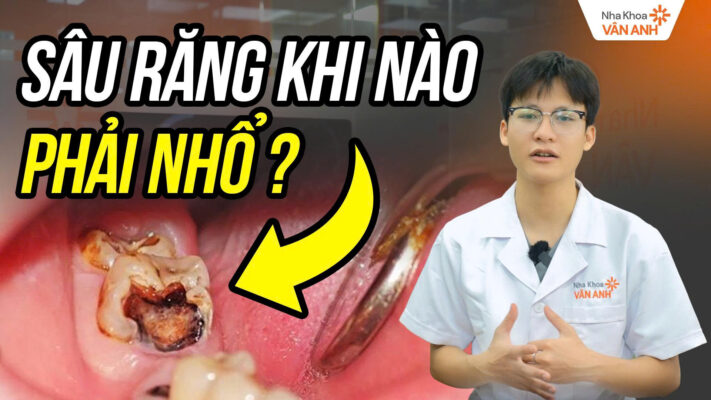 sâu răng khi nào phải nhổ