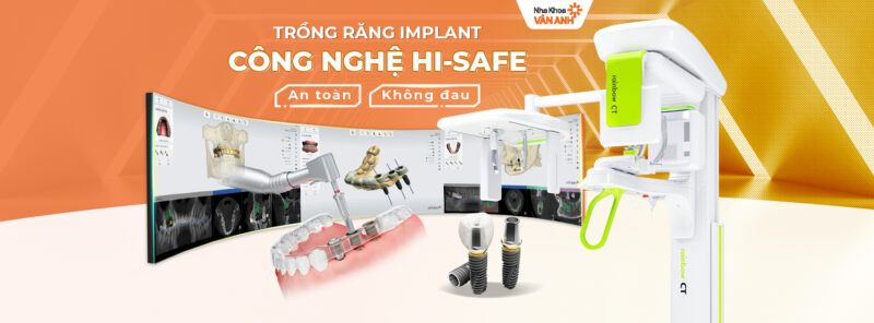 công nghệ trồng răng nha khoa vân anh