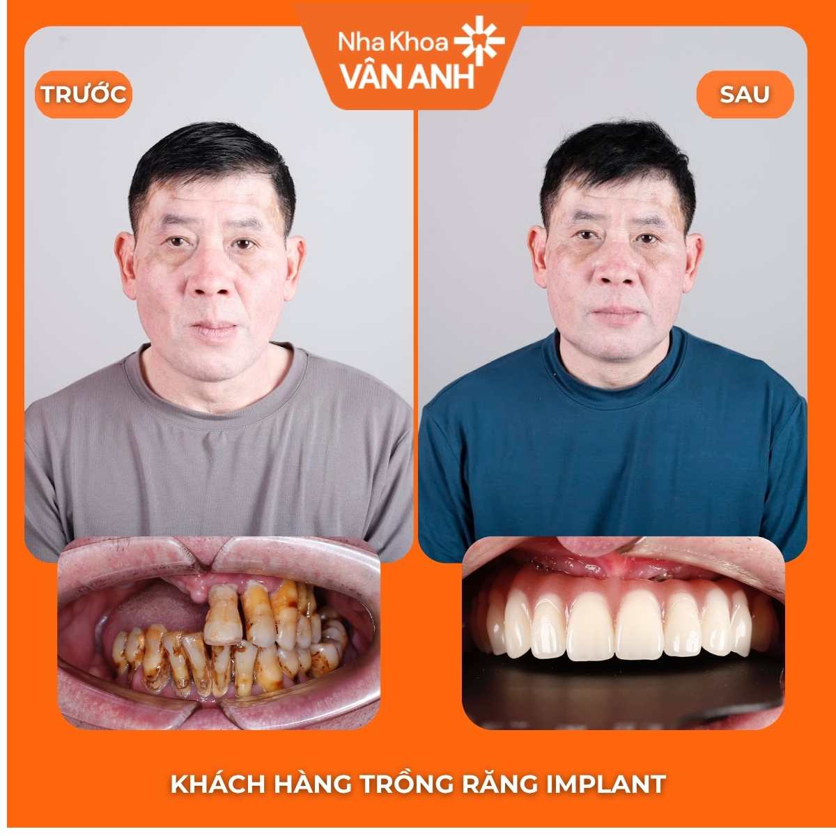 Ca 04 trước và sau điều trị