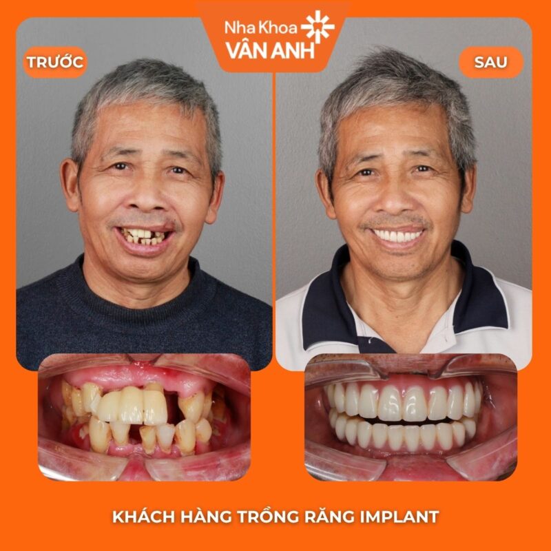 trồng răng implant nha khoa vân anh