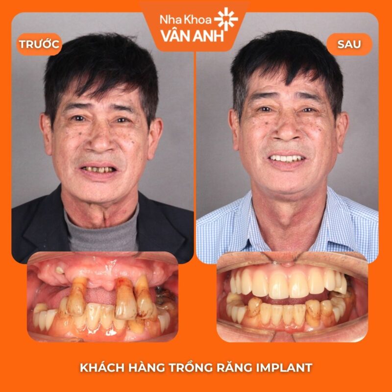 trồng răng implant nha khoa vân anh