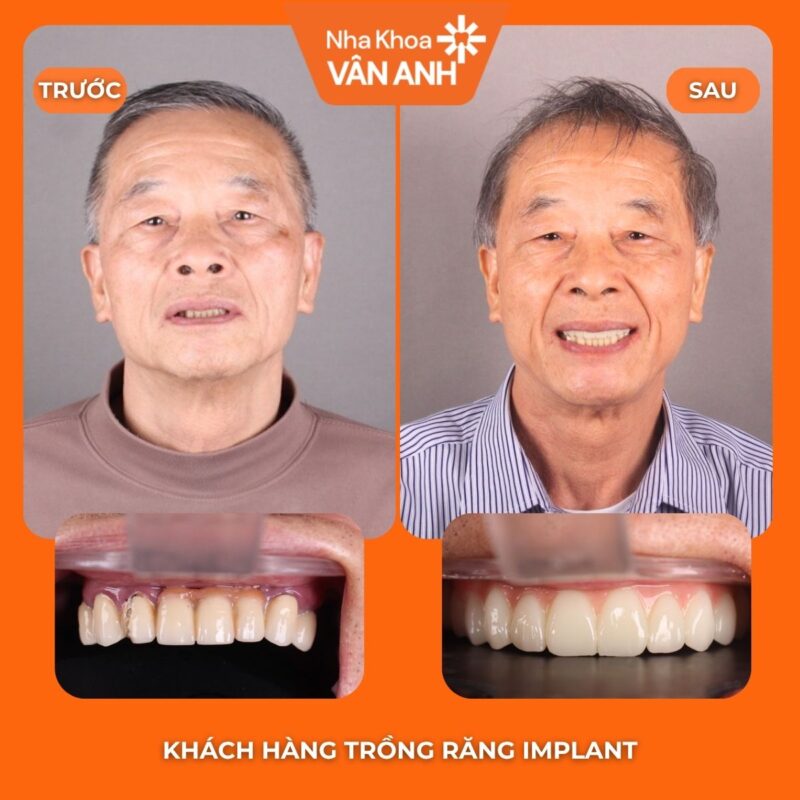 trồng răng implant nha khoa vân anh