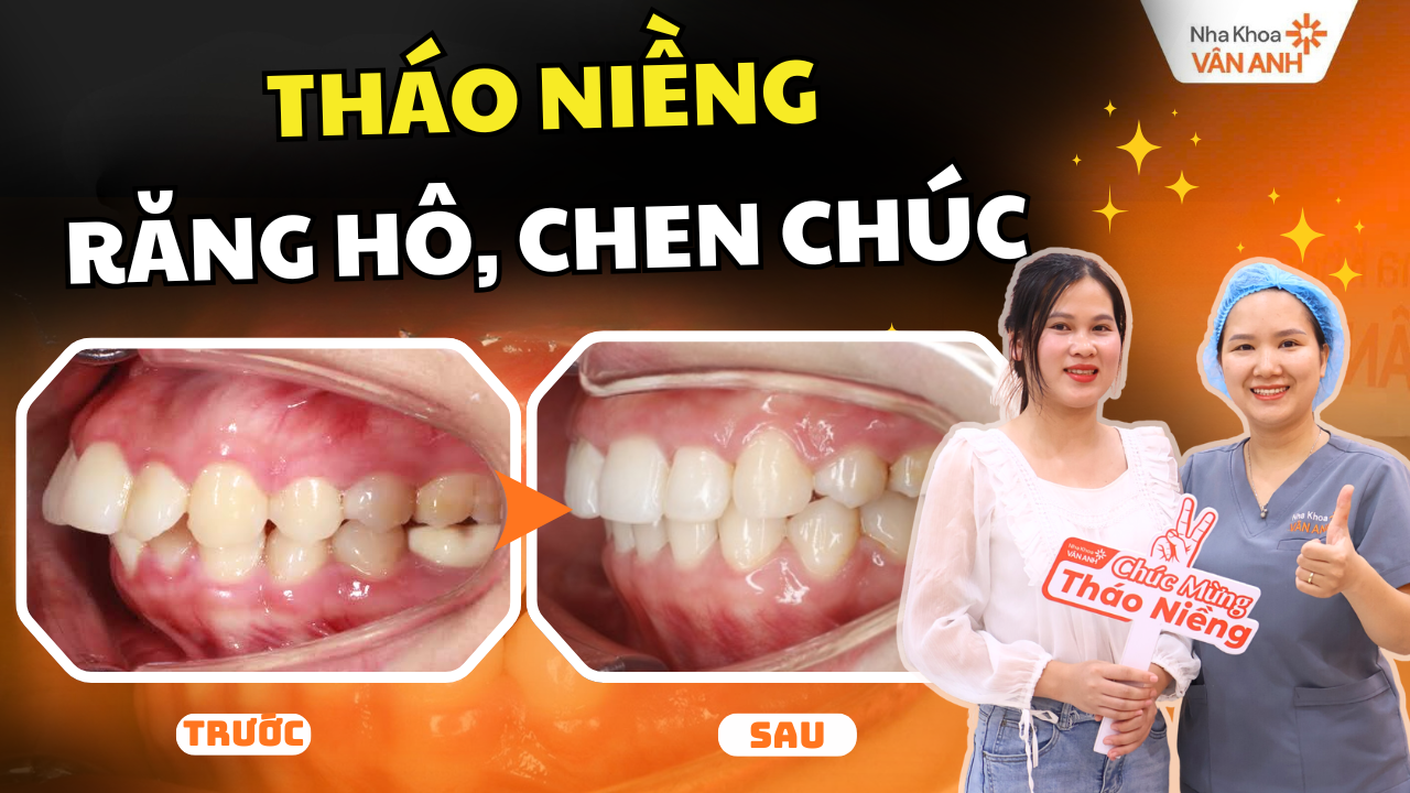 tháo niềng nha khoa vân anh