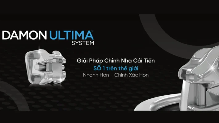 mắc cài kim loại damon ultima