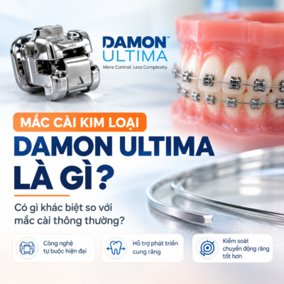 mắc cài tự buộc nong rộng damon ultima