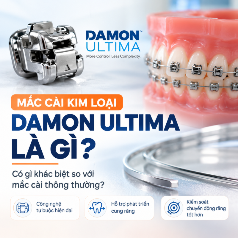 mắc cài tự buộc nong rộng damon ultima