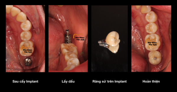 Trụ răng và răng sứ Implant